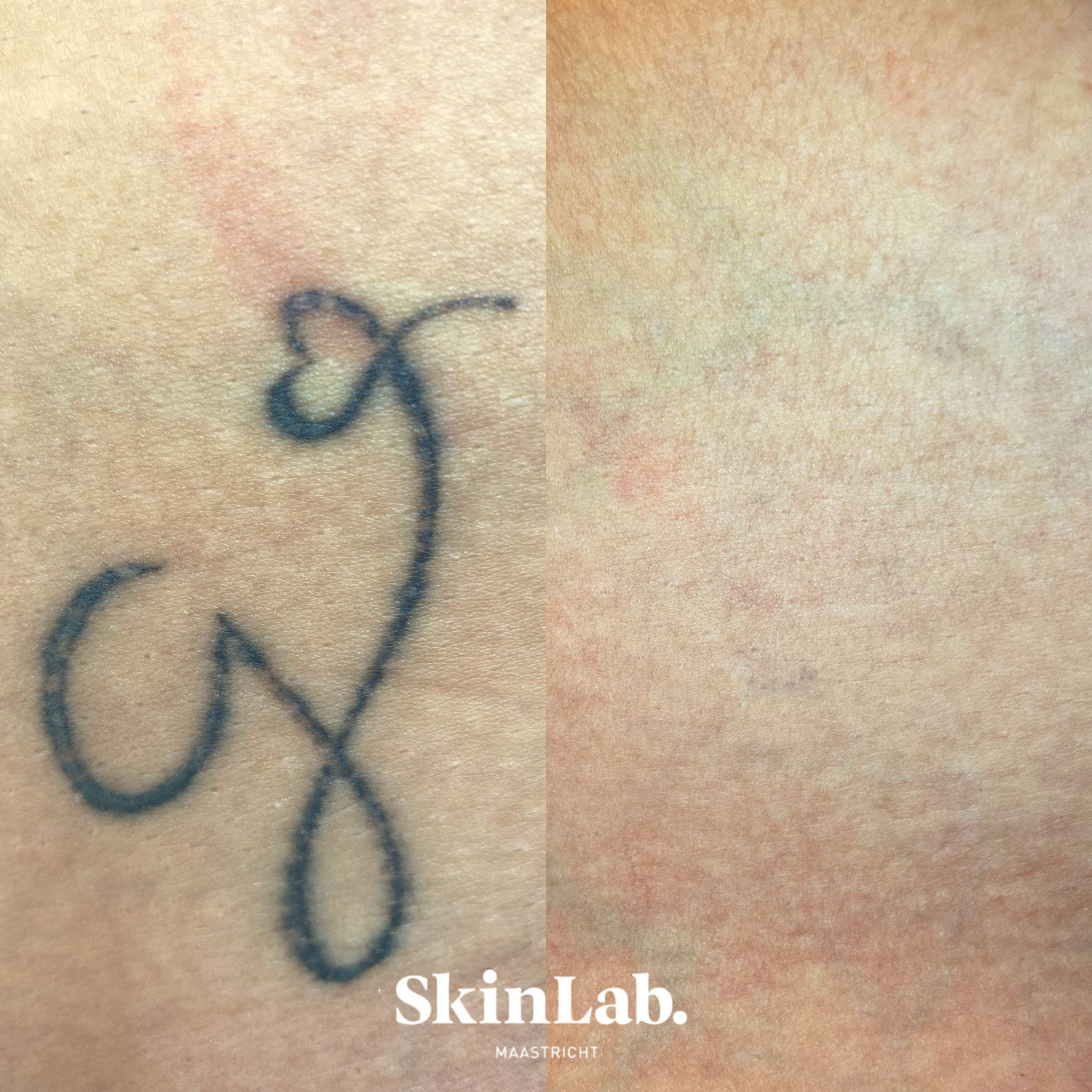 Tattoeage verwijdering 9