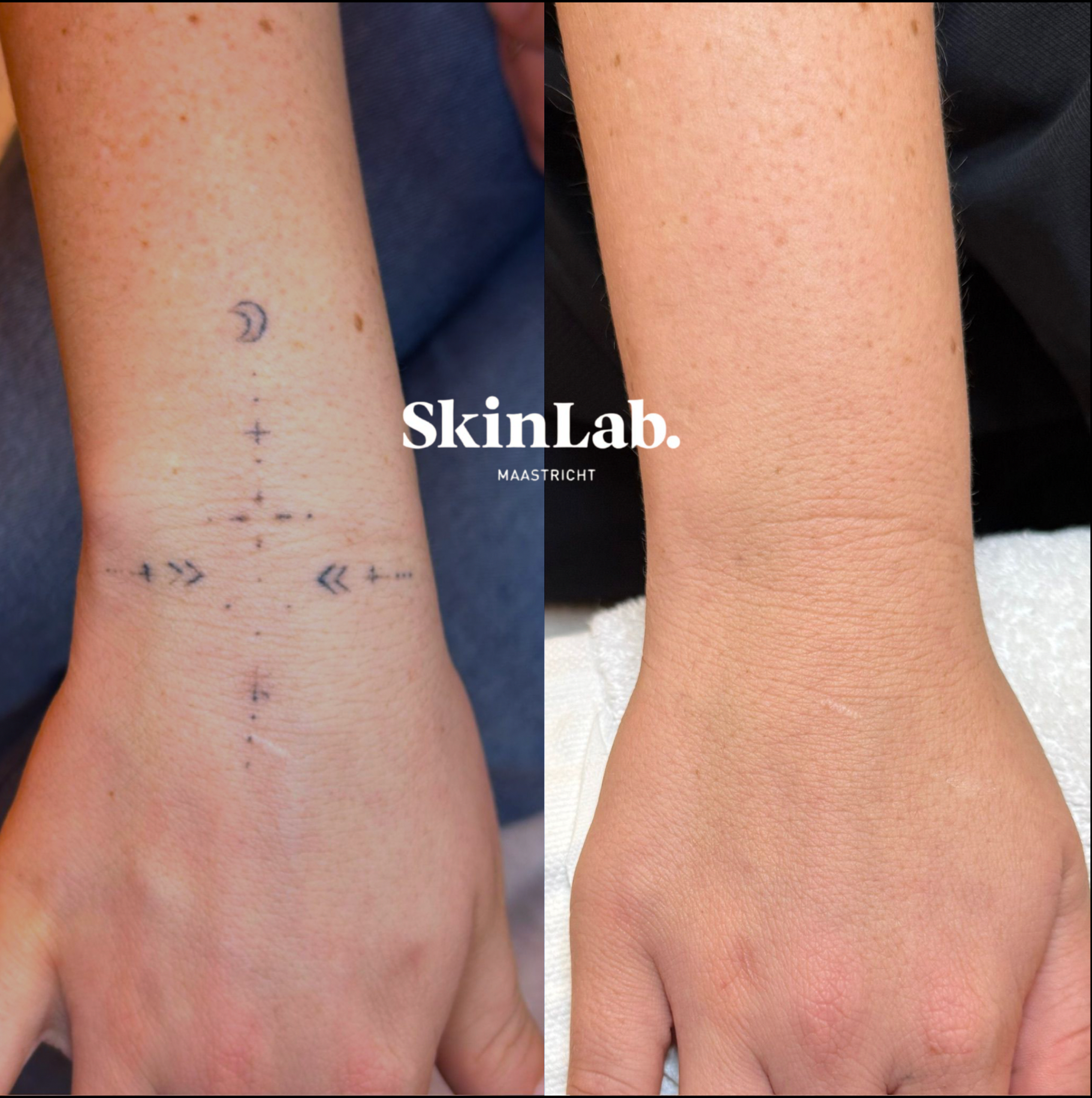 Tattoeage verwijdering 7