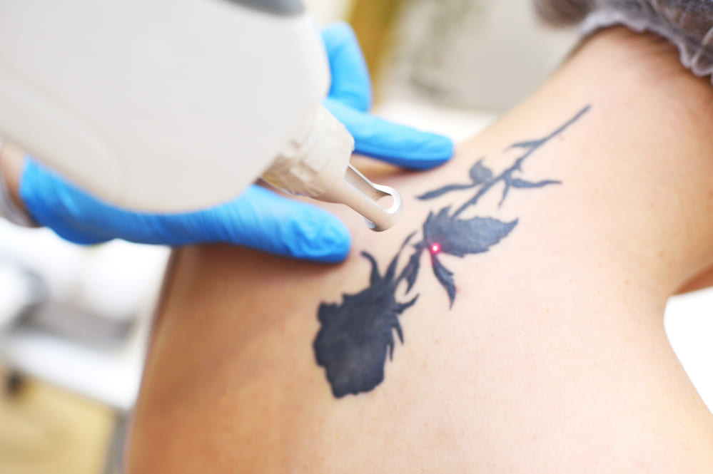 tattoo verwijderen met lasertherapie